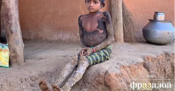 В Индии девочка превращается в камень из-за неизлечимой болезни