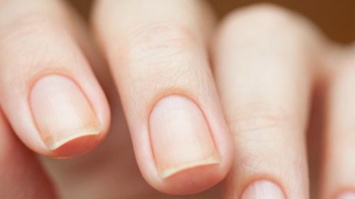 О каких болезнях говорят полосы на ногтях