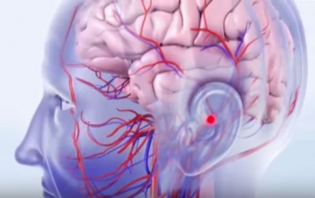 Медики предупредили: первые признаки инсульта, как оказать помощь