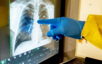 Облздрав назвал количество умерших от пневмонии на Херсонщине за последние 3 месяца