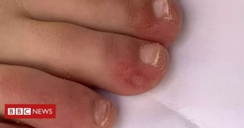 "Ковидные пальцы" и сыпь как симптомы Covid-19