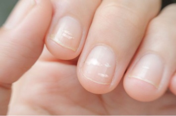 О какой опасности могут предупредить белые полоски на ногтях