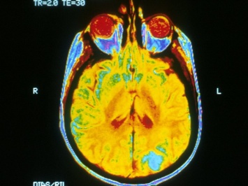 Для болезни Альцгеймера могут предложить новую диагностику
