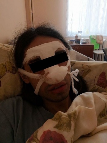 В Харькове трое неизвестных избили девушку-трансгендера и сломали ей нос, - ФОТО