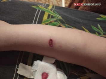 В Кривом Роге привязанная возле госучреждения собака искусала 3-летнюю девочку