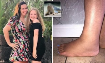 Новая 13-летнюю девочку на пляже "ужалила" рыба - палец сразу почернел, а нога распухла вдвое (фото)