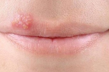 Герпес на губе: как быстро и натуральными способами избавиться от болячки