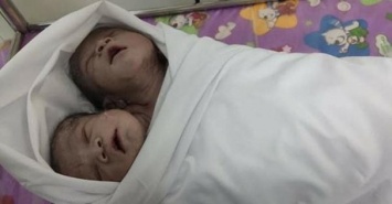В Мьянме родились сиамские близнецы с общим телом и двумя головами (фото)