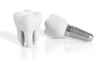 Имплантация зубов: как избежать осложнений и повысить приживаемость?