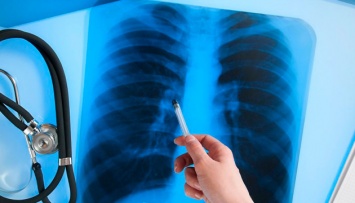 В Украине за год туберкулез диагностируют у почти тысячи детей - эксперты