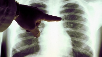Почему развивается рак легких у некурящих: медики назвали главные причины