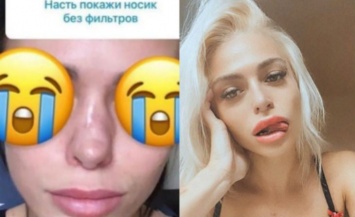 Звезда «Дома-2» Анастасия Балинская показала испорченный ринопластикой нос