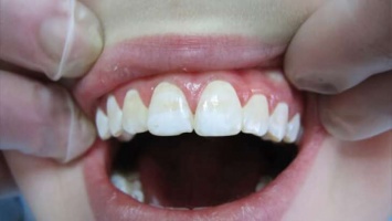 Как избавиться от желтого налета на зубах?