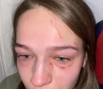 Украинке в самолете расцарапали лицо и отгрызли ноготь: блогер рассказал детали