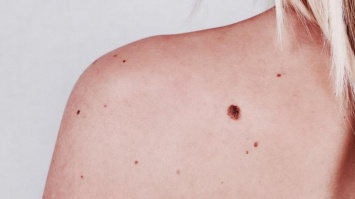 Рак кожи: первые симптомы, на которые стоит обратить внимание