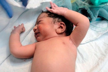 В Израиле родилась девочка с эмбрионом внутри живота