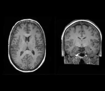 Суперкомпьютер научили создавать МРТ мозга для быстрого исследования болезней