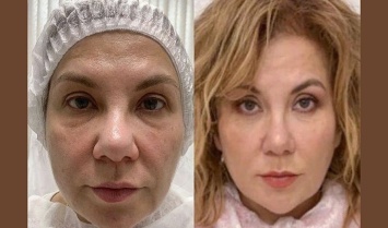 Марина Федункив без операции уменьшила нос и подкорректировала овал лица