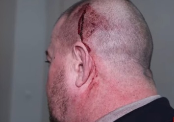 Драка в Одесской мэрии: нардеп Артем Дмитрук разбил голову директору охраны