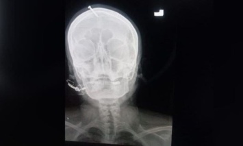 Беременная женщина вбила себе в голову пятисантиметровый гвоздь: мозг не пострадал